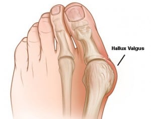Hallux valgus