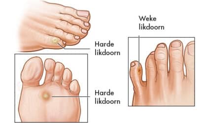 Eeltpit, eksteroog of likdoorn