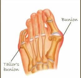Tailorsbunion
